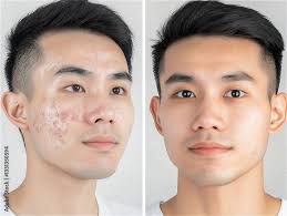 Original Face Cream – Acne Remove & Deep Skin Clean | Clear, Smooth & Fresh Look