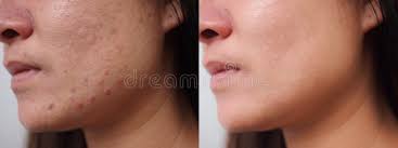 Original Face Cream – Acne Remove & Deep Skin Clean | Clear, Smooth & Fresh Look